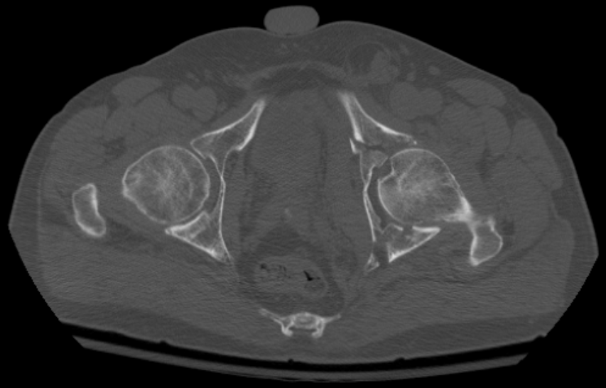 Acetabular fracture