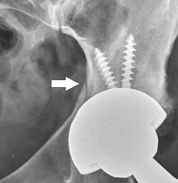Acetabular fracture