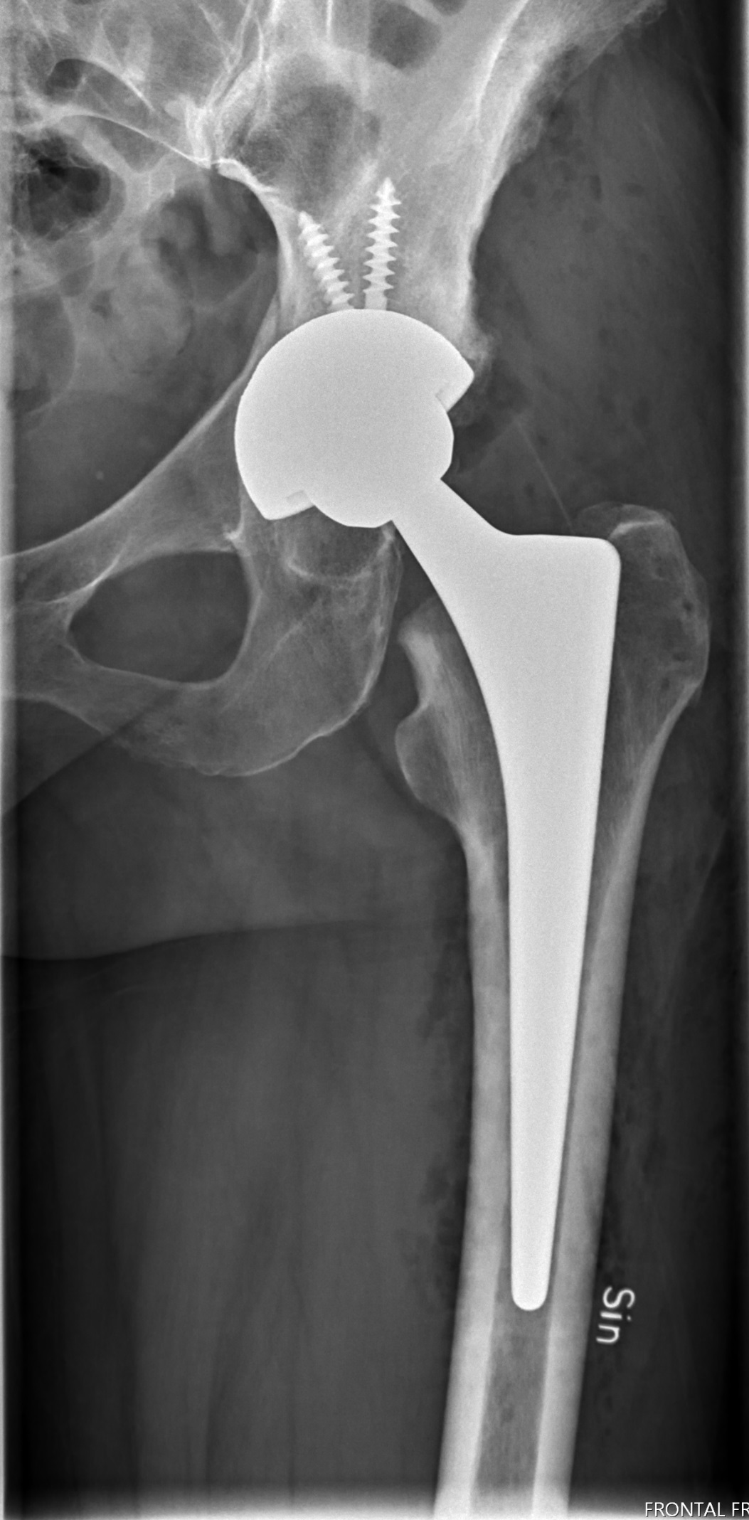 Acetabular fracture