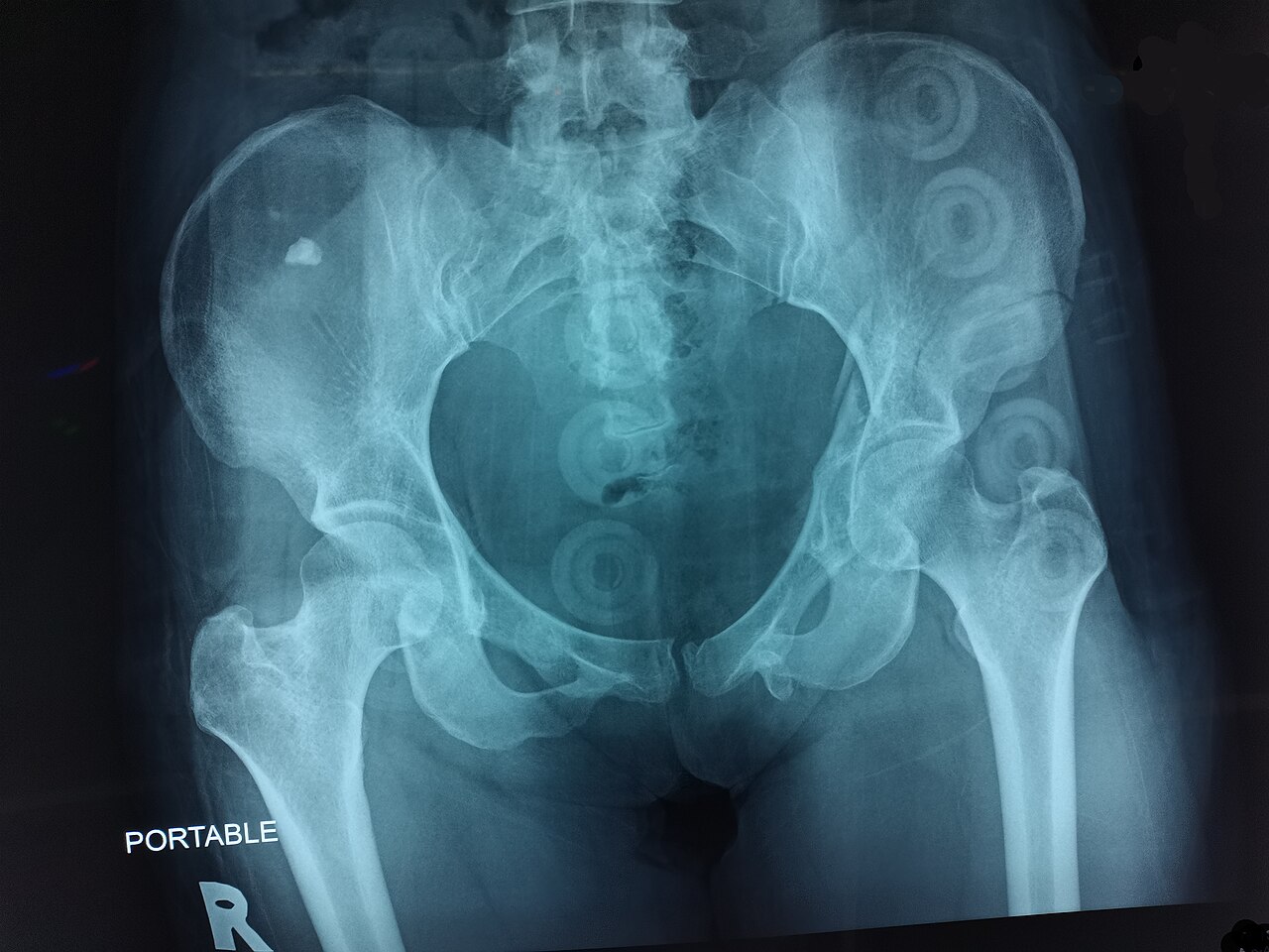 Acetabular fracture