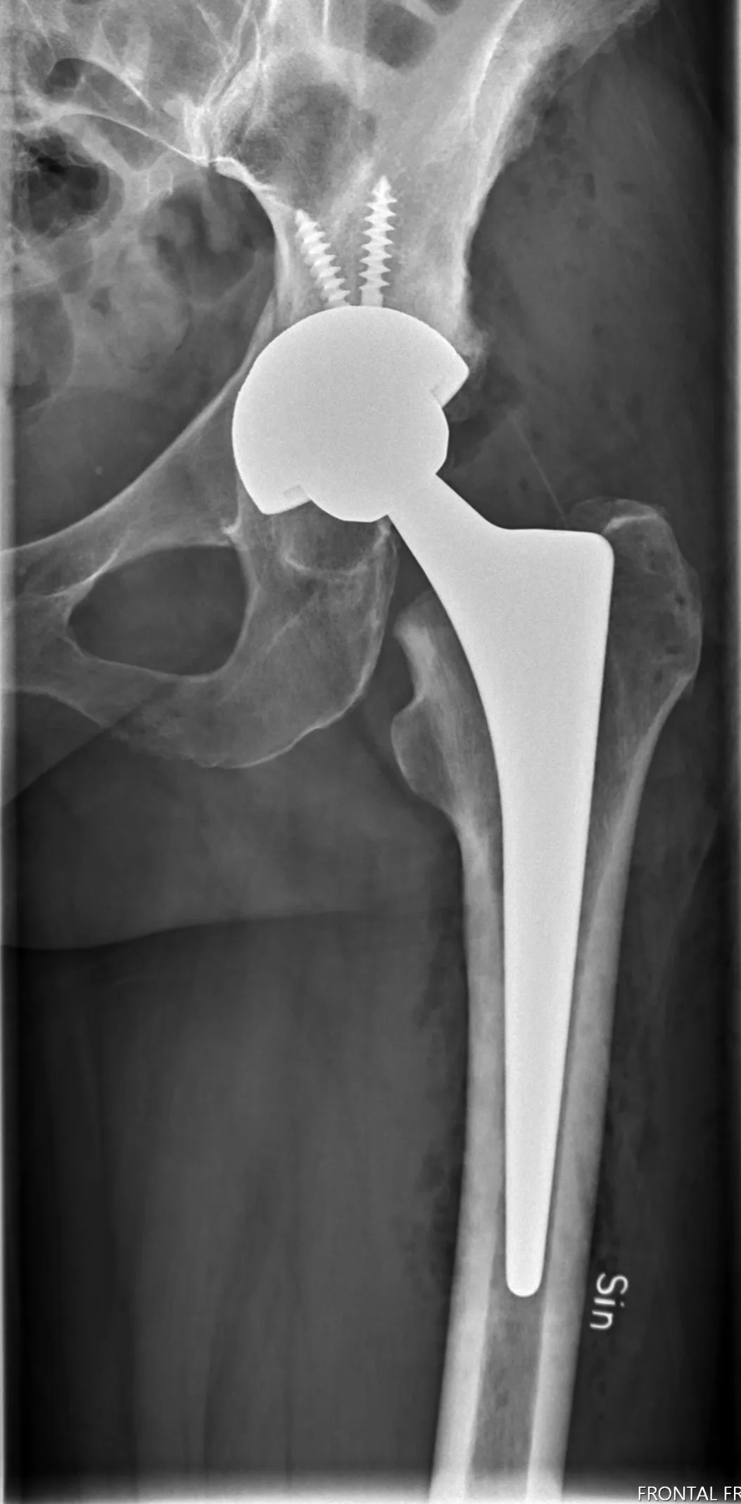 Acetabular fracture