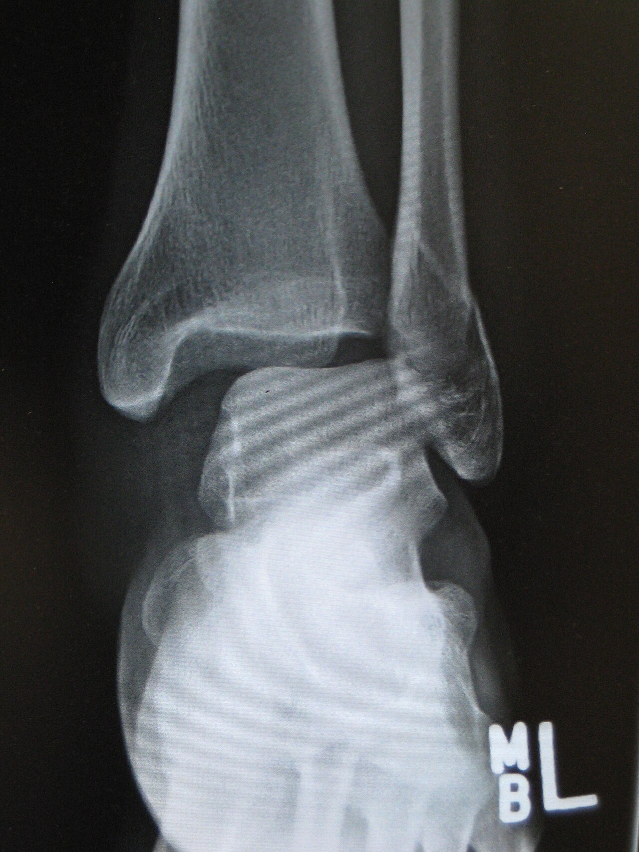 Ankle fracture