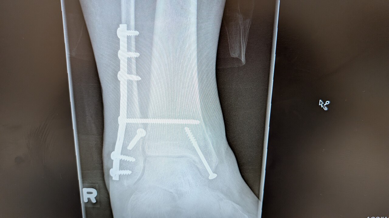 Ankle fracture