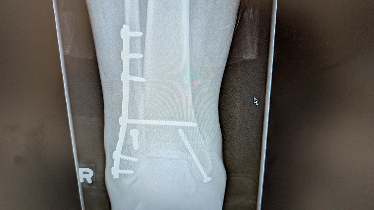 Ankle fracture