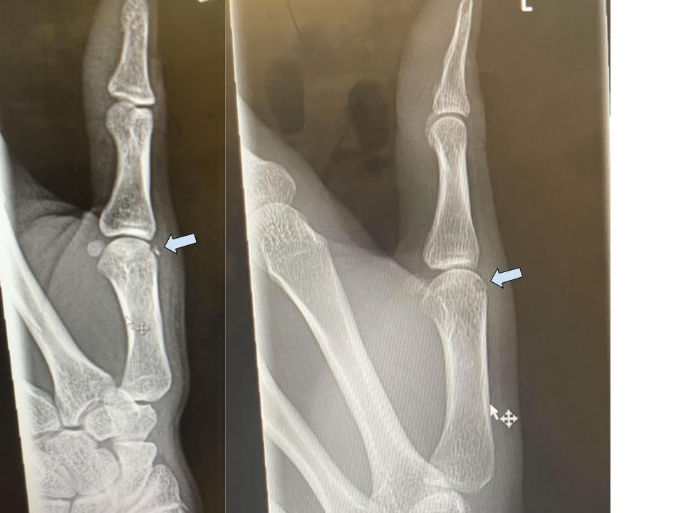 Avulsion fracture