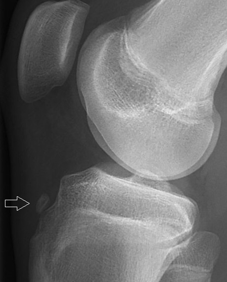 Avulsion fracture