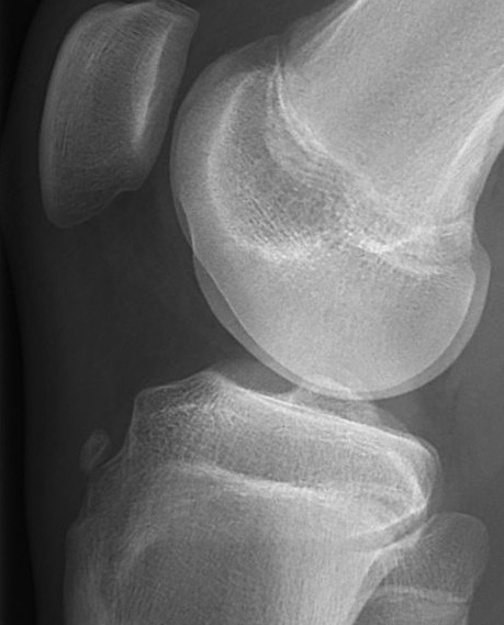 Avulsion fracture