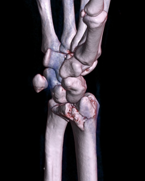 Barton's fracture