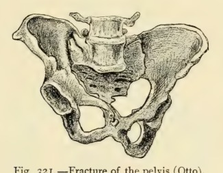 Barton's fracture