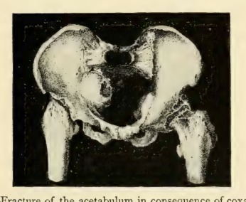 Barton's fracture