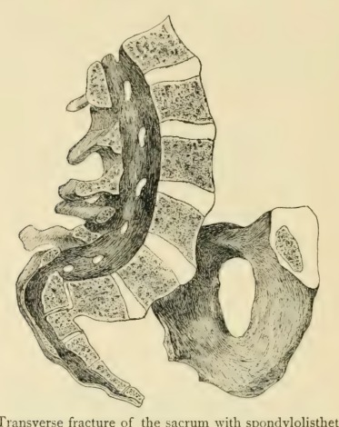 Barton's fracture