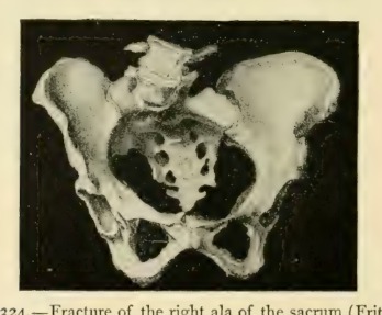 Barton's fracture
