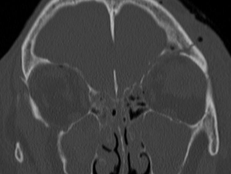 Basilar skull fracture