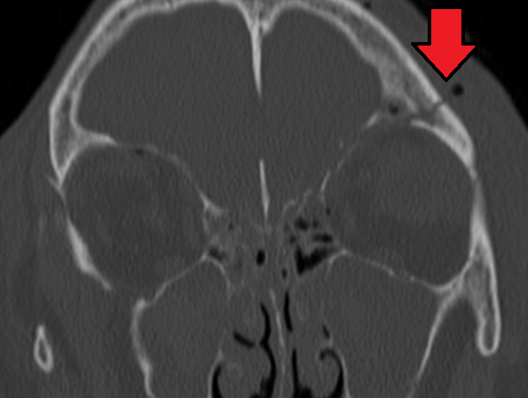 Basilar skull fracture