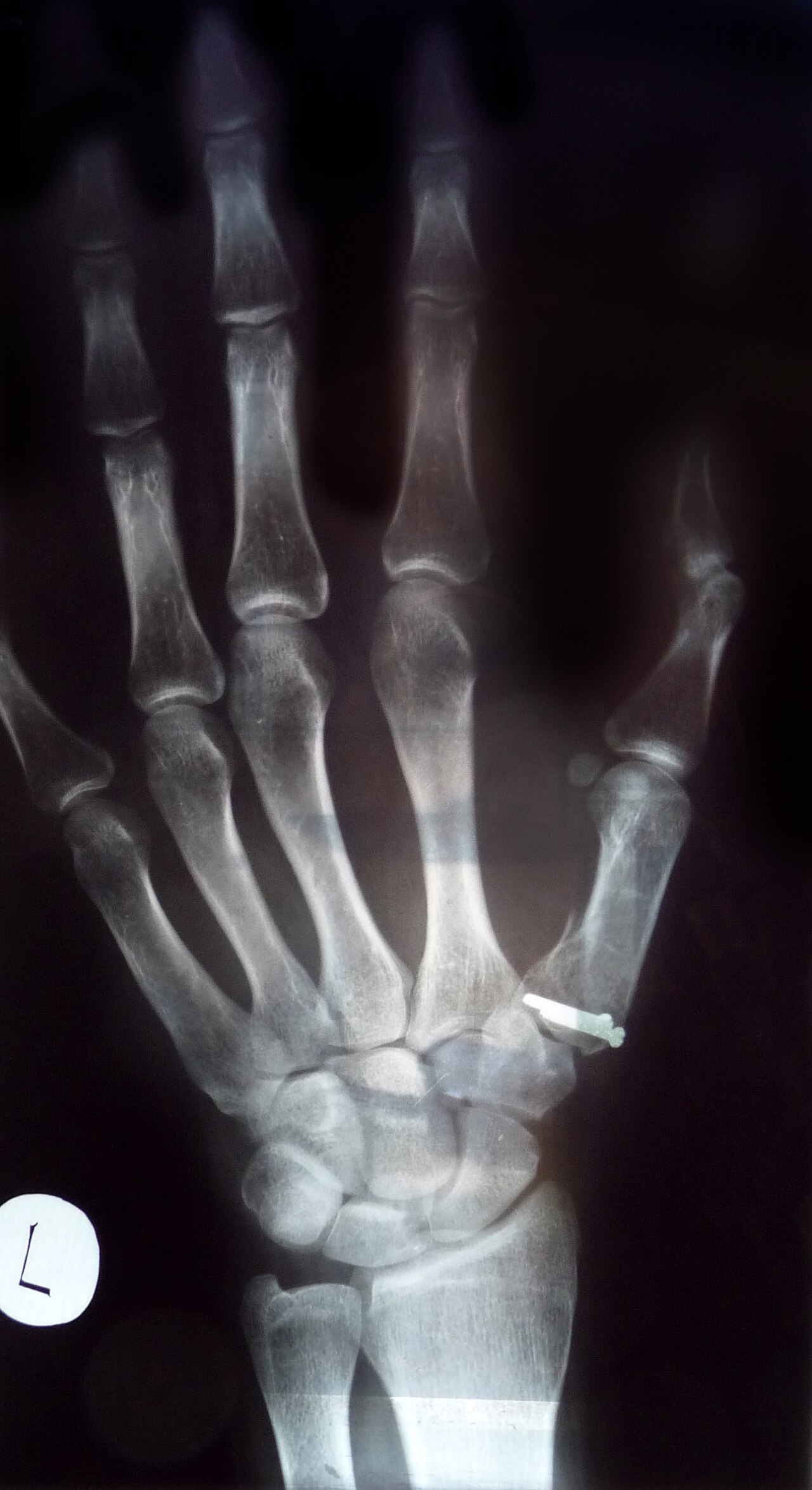 Bennett's fracture