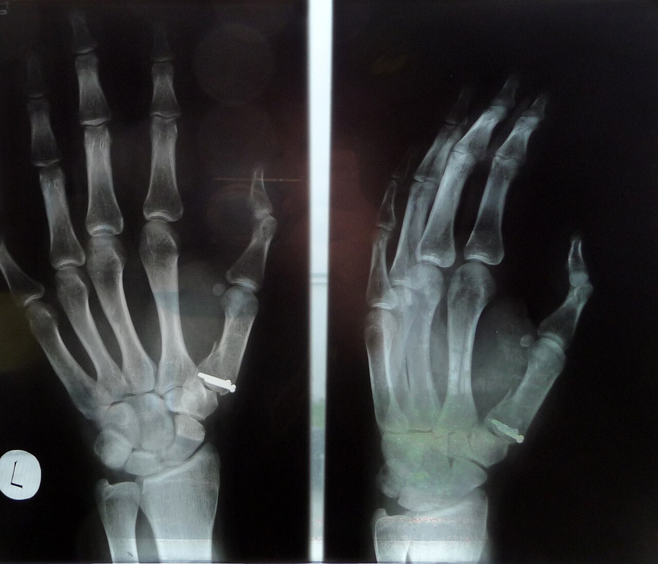 Bennett's fracture
