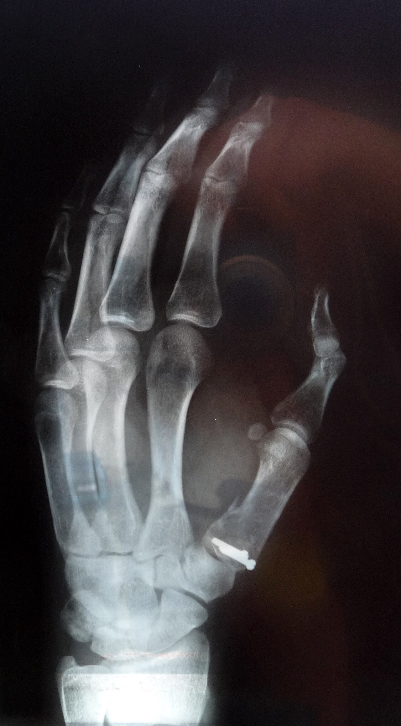 Bennett's fracture