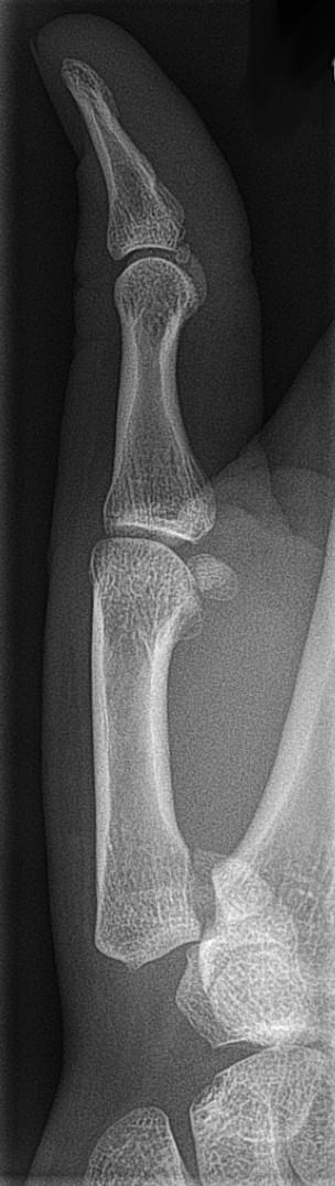 Bennett's fracture