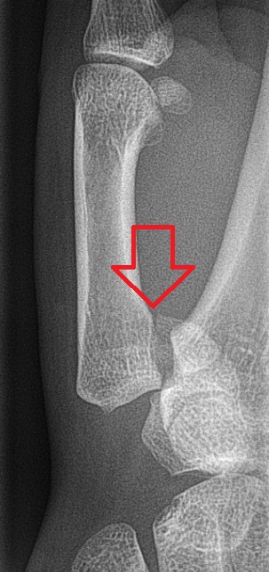 Bennett's fracture