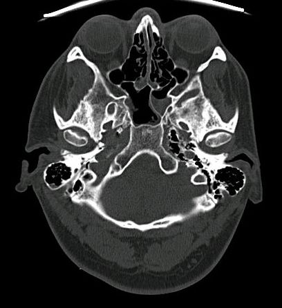 Bone fracture