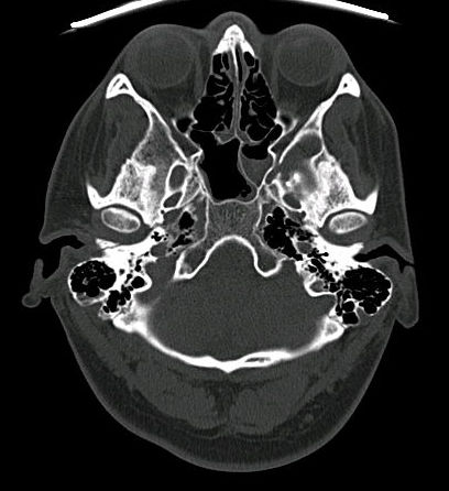 Bone fracture