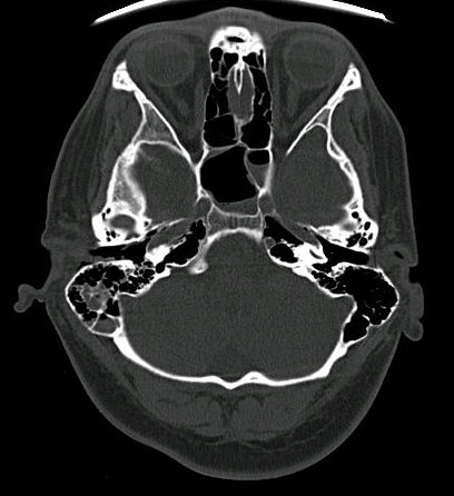 Bone fracture