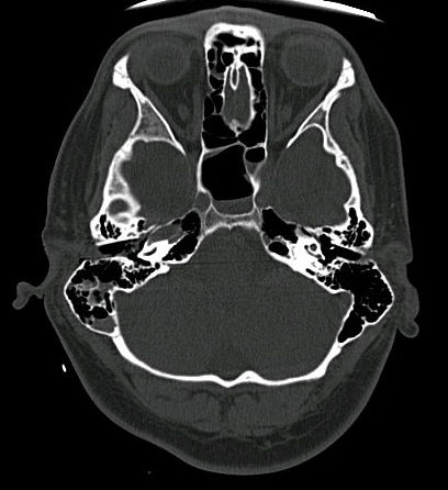 Bone fracture