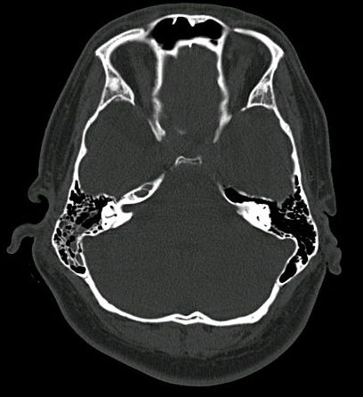 Bone fracture