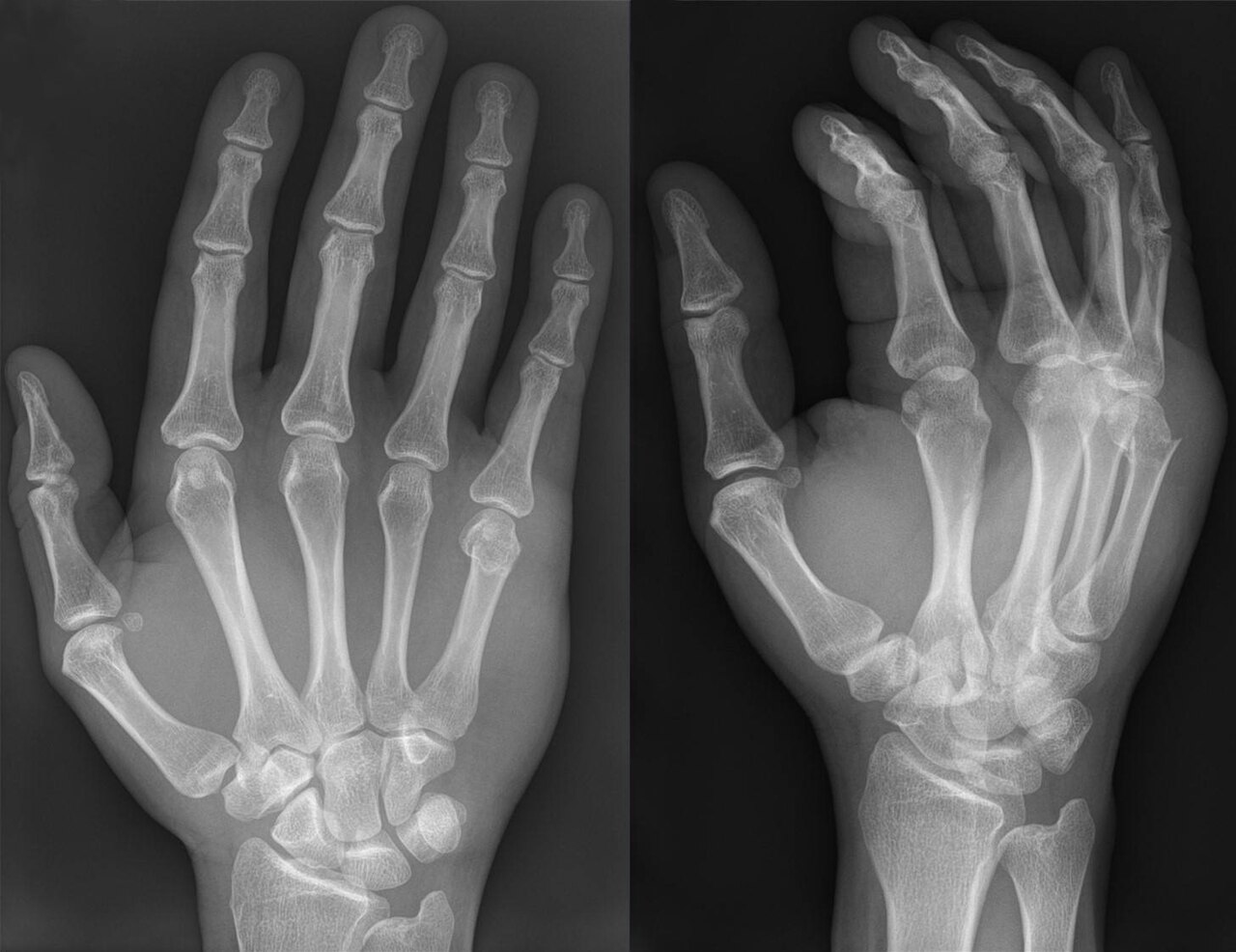 Boxer's fracture