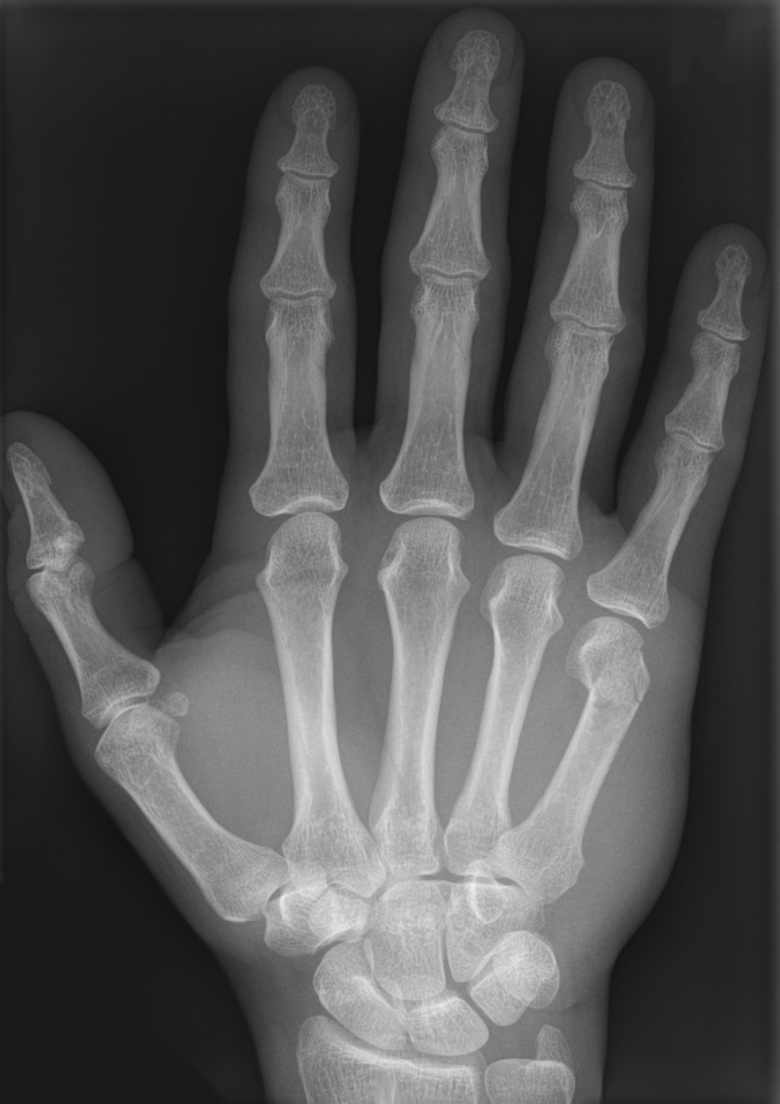 Boxer's fracture