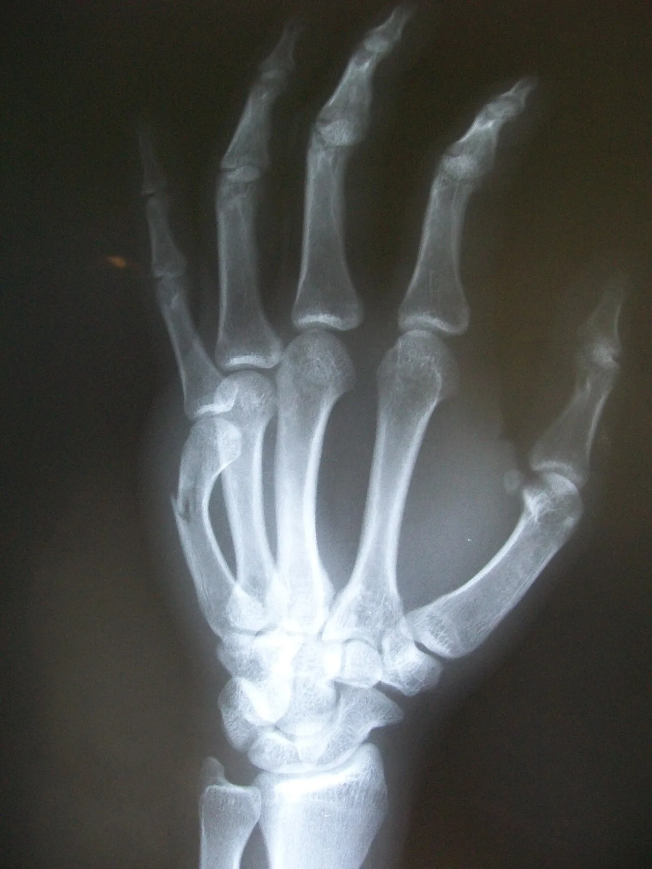 Boxer's fracture