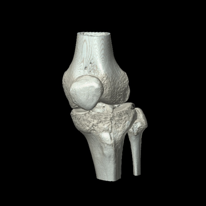 Bumper fracture