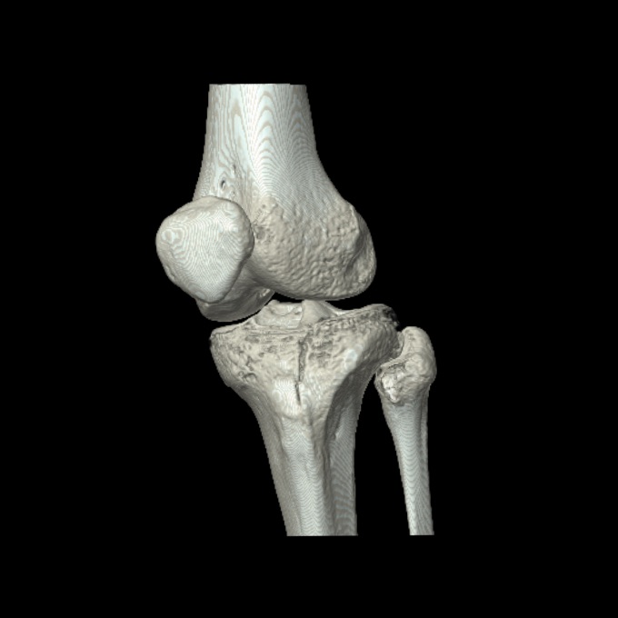 Bumper fracture