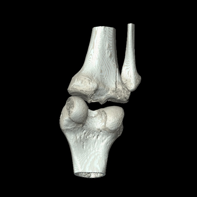 Bumper fracture